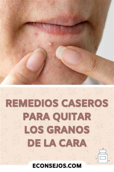 Cómo Quitar Los Granos De La Cara Usando Remedios Caseros Remedio