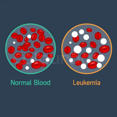 Leukemia Vector Icon Illustration Stock Vector Colourbox