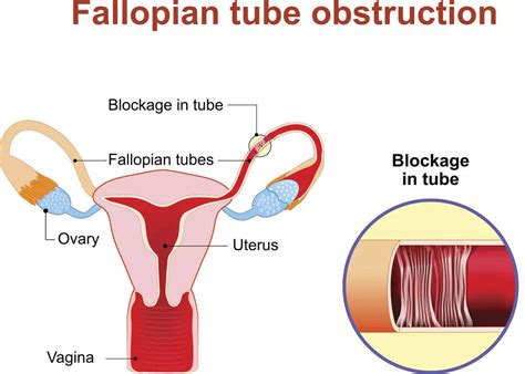 blocked fallopian tubes causes symptoms and treatment options for women who wish to conceive