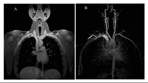 A T1 Vibe Fat Sat Postcontrast Coronal Image Demonstrating The