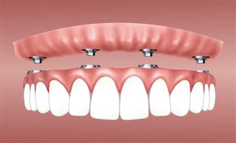 What Are Overdentures An Overview Meng Dentistry