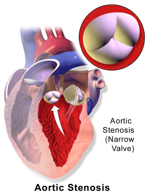 Difference Between Mitral Valve And Aortic Valve Compare The