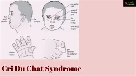 Cri Du Chat Syndrome Causes Of Cats Cry Syndromes
