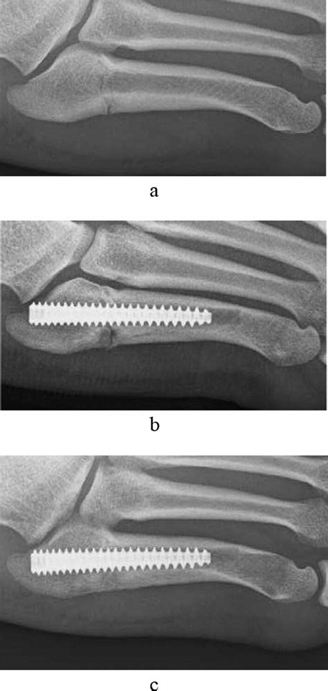 A The Proximal Fifth Metatarsal Bone Fracture Of The Right Foot Had A