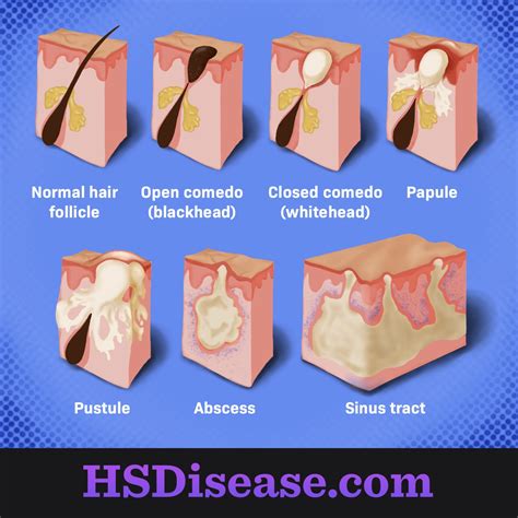 Hidradenitis Suppurativa Symptoms Bumps