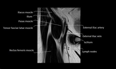 Mri anatomy of the ankle tendons and ligaments. anatomy of hip joint | free MRI coronal cross sectional ...