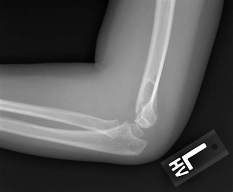 Diagnose On Sight 6 Year Old With Elbow Pain