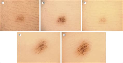 Variations In The Dermoscopic Features Of Acquired Acral Melanocytic