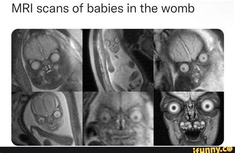 Mri Scans Of Babies In The Womb