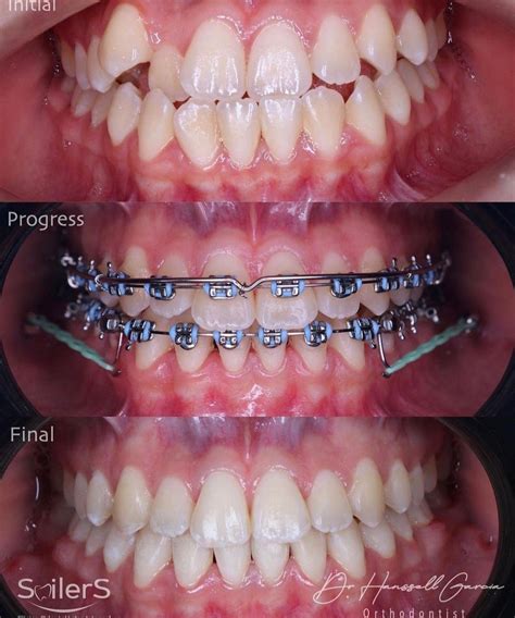 Orthodontist Braces Tooth Projects To Try Initials Pins Quick Dental Health Orthodontics
