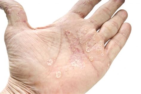 5 Types Of Plaque Psoriasis And Their Treatment Options The Frisky