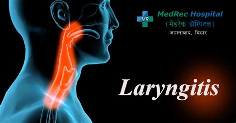 laryngitis prevention symptoms and treatment options