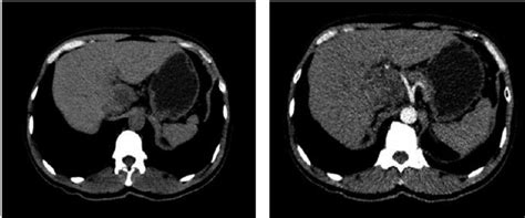 Ct Scan Showed A Large Lesion Arise From The Caudate Lobe Case 3