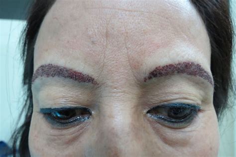 Iron deficiency is the most common culprit of hair thinning and loss in women. Eyebrow Hair Transplant | Eyebrow Restoration Cost and ...