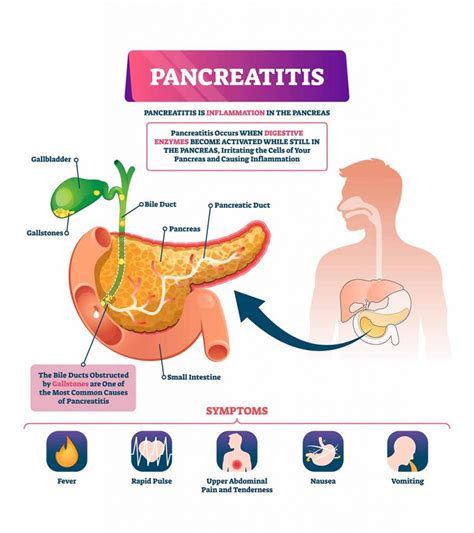 Pancreatitis In Children Symptoms Diagnosis And Treatment