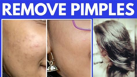 How To Remove Pimples Scars Naturally And Effectively In Home Pimple
