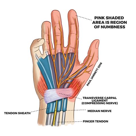 Carpal Tunnel Syndrome Murdoch Orthopaedic Clinic