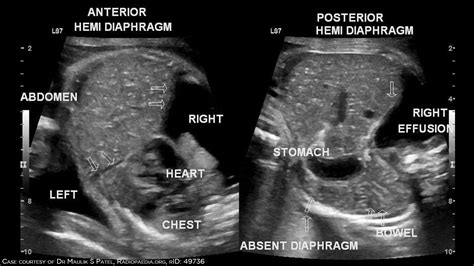 Congenital Diaphragmatic Hernia Ultrasound
