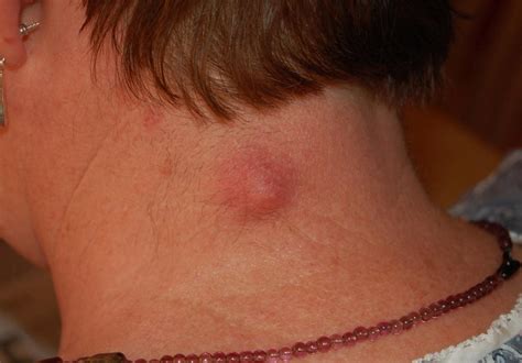 What Do Cancerous Lumps On Neck Look Like Woman Left With 10 Inch