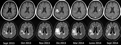 The influence of gonadal hormones on multiple sclerosis is not well characterised and has thus far been investigated. Leucoencefalopatía multifocal progresiva asociada al ...