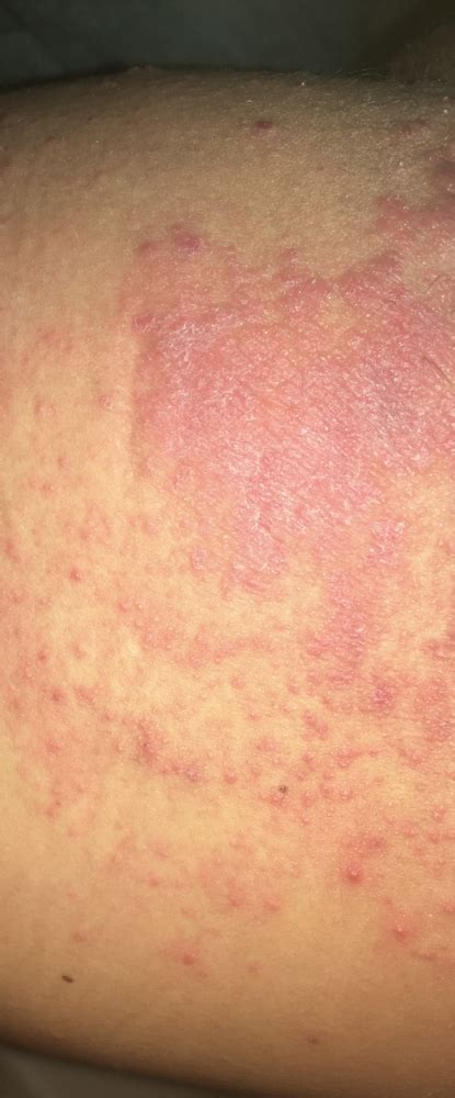 Yeast Skin Rash Fungal And Yeast Infections Forums Patient
