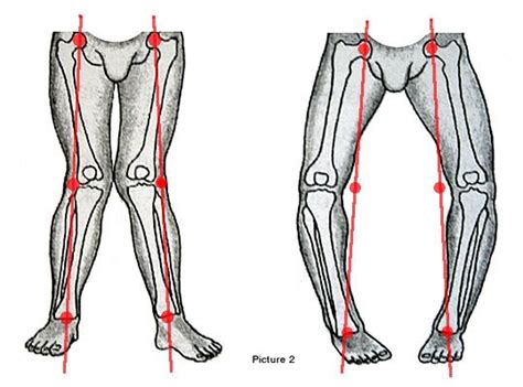 Orthopedic Bowed Legs