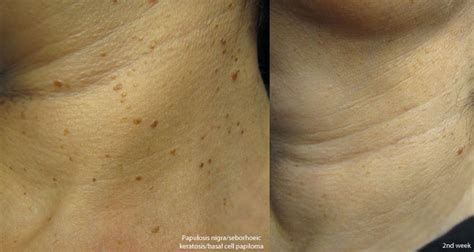 Wart Removal Marsden Skin Cancer Clinic