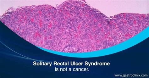 Solitary Rectal Ulcer Syndrome Dr Harsh J Shah