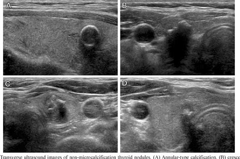 Figure 2 From Relationship Between Patterns Of Calcification In Thyroid