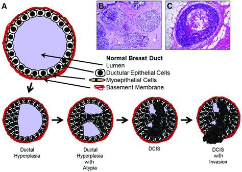 A Natural History Of Breast Ductal Carcinoma In Situ Dcis And