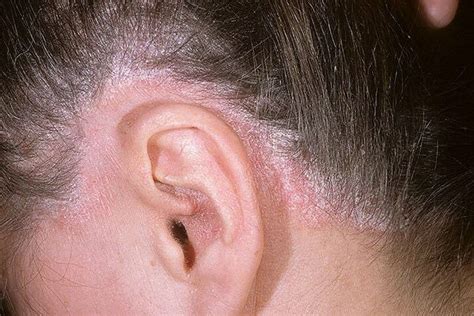 Psoriasis On The Head Photo How To Treat The Disease On The Scalp