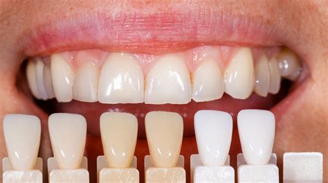 Porcelain Vs Composite Veneers Cosmetic Dentistry