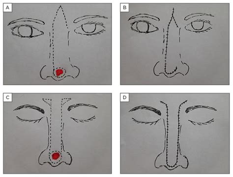 Reconstructive Options For Cutaneous Defects Of The Nose A Review