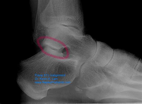 Dr K Lam Straight Talk Pain In The Ankle Subtalar Joint On Uneven