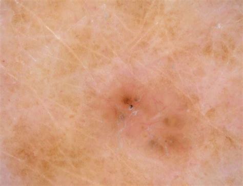 Dermatoscopie Van Het Basaalcelcarcinoom Dermatoscopienl