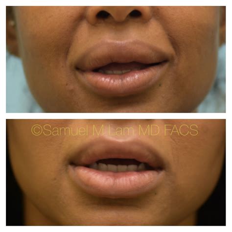 this african american woman is shown before and 5 months after upper and lower lip reduction to