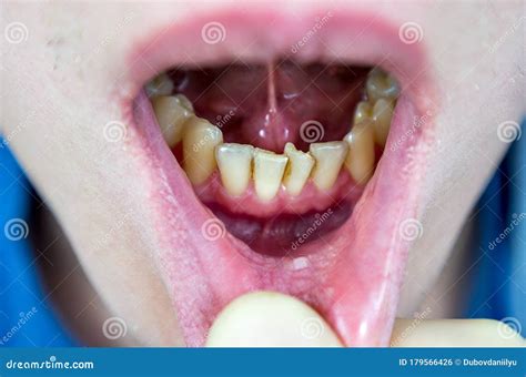 Crooked Teeth In The Anterior Part Of The Patient At The Reception Of The Orthodontist Dentist