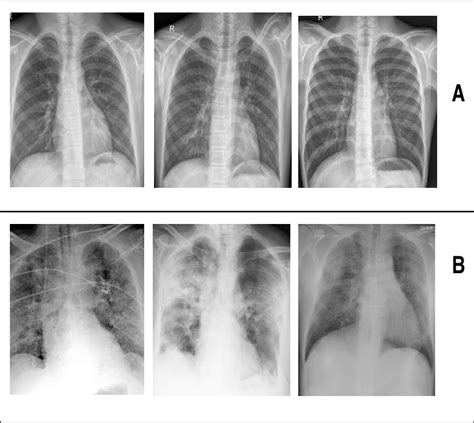 Comparison Of Different Chest X Ray Of Normal And Covid 19 Patients