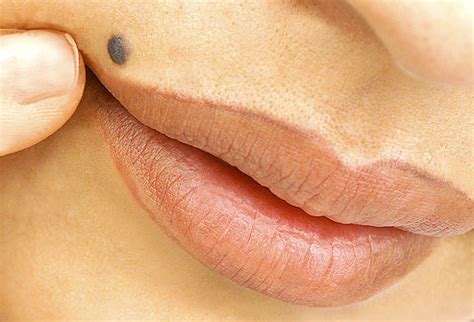 Many women who have vulvar cancer have signs and symptoms. Groin skin cancer in men ~ All about Health