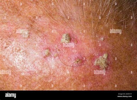 Close Up Of Solar Actinic Keratoses On The Scalp Of An 85 Year Old