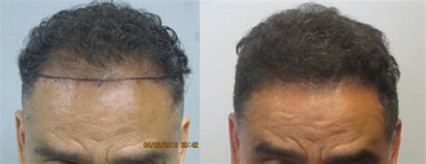 Prospective los angeles hair restoration patients now have amazing resources to achieve their los angeles hair restoration surgeon, dr. Los Angeles hair transplant pictures