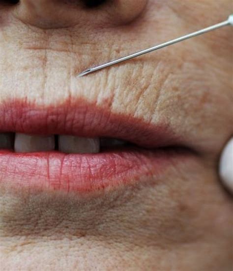 Solutions For Smokers Lines And Wrinkles Around Lips Dr Kally