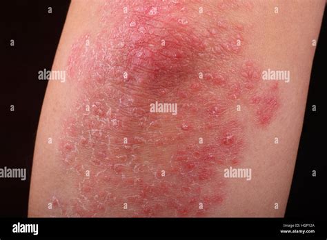 Psoriasis On An Elbow Showing Redness And Dry Patches Stock Photo Alamy