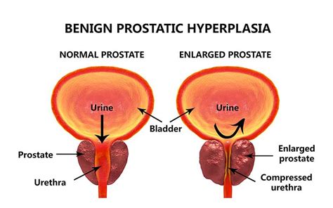 Urinary symptoms also can be caused by an infection of the bladder or other conditions. Prostate Cancer Overview: Signs, Symptoms, Screening, and ...