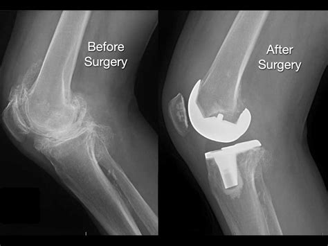Total Knee Arthroplasty To Correct Stiffness Plastic Surgery Key My
