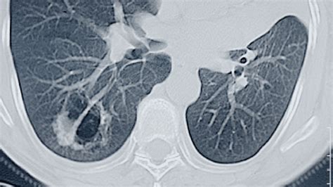 Uspstf Expands Lung Cancer Screening Criteria Medpage Today