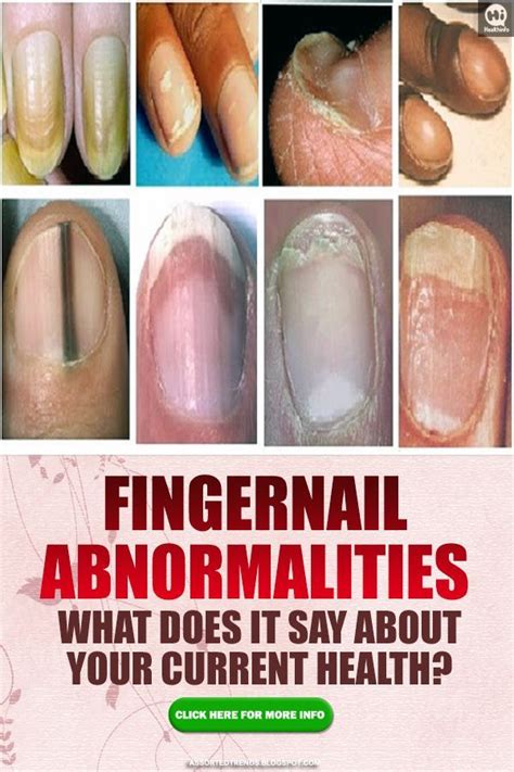 Fingernail Abnormalities What Does It Say About Your Current Health