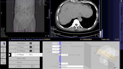 How To Make Ct Scan Of Whole Abdomen Siemens In Syngo Acquisition