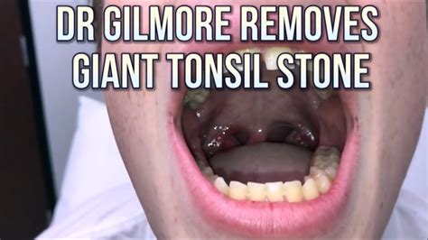 Worst Tonsil Stones In Texas Tonsil Stone Popping 💉👍😷😆 Youtube