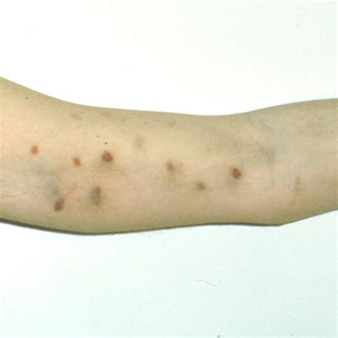 Skin Cancer Lesions On Arms